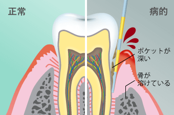 歯周病治療